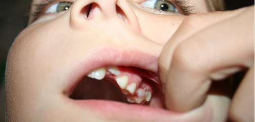 印度女童嘴莫名肿痛 医生取出202颗牙齿(图)