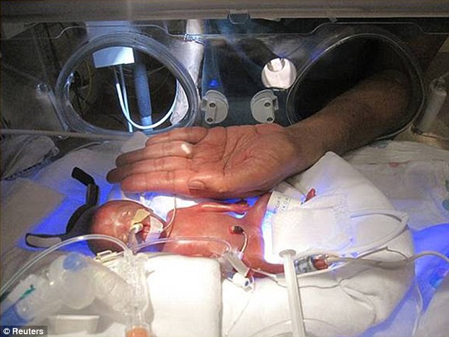 全球第三小婴儿奇迹存活出院回家 出生时体重比一罐可乐轻