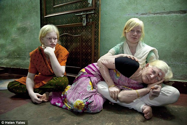 印度一家十口全患白化病 打破吉尼斯世界纪录
