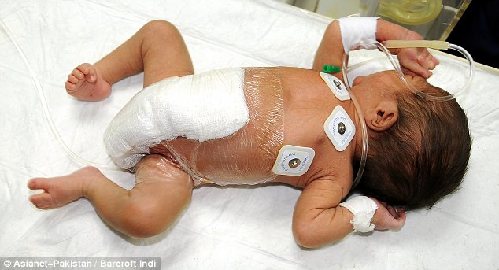 巴基斯坦六腿婴儿成功进行截肢手术 父母为近亲结婚