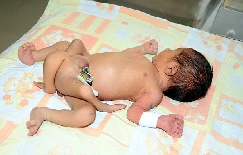 巴基斯坦六腿婴儿成功进行截肢手术 父母为近亲结婚