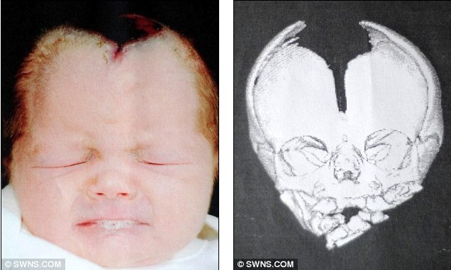 英国两岁女孩天生头盖骨残缺 哭泣可能会危及生命
