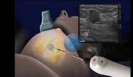 不开刀无疤痕 以色列科学家开发乳腺癌“冰球”疗法