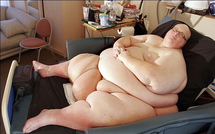 原世界最胖男子减肥后皮肤下垂 渴望切除多余皮肤