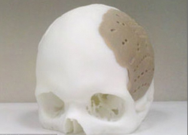 头骨也能打印！美国3D打印技术造福移植患者
