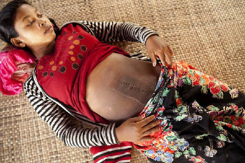 柬埔寨新生婴儿的死亡