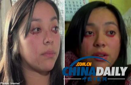 智利少女患罕见疾病 眼睛流血不流泪