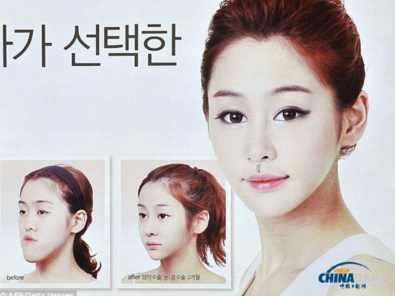 嘴部整形手术风靡韩国 旨在打造迷人“微笑弧度”