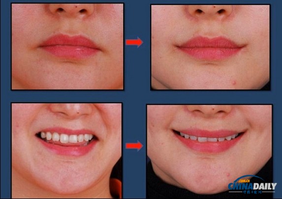 嘴部整形手术风靡韩国 旨在打造迷人“微笑弧度”