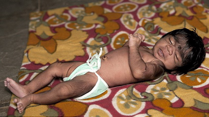 印度女婴患罕见狼人综合症 全身被黑色毛发覆盖