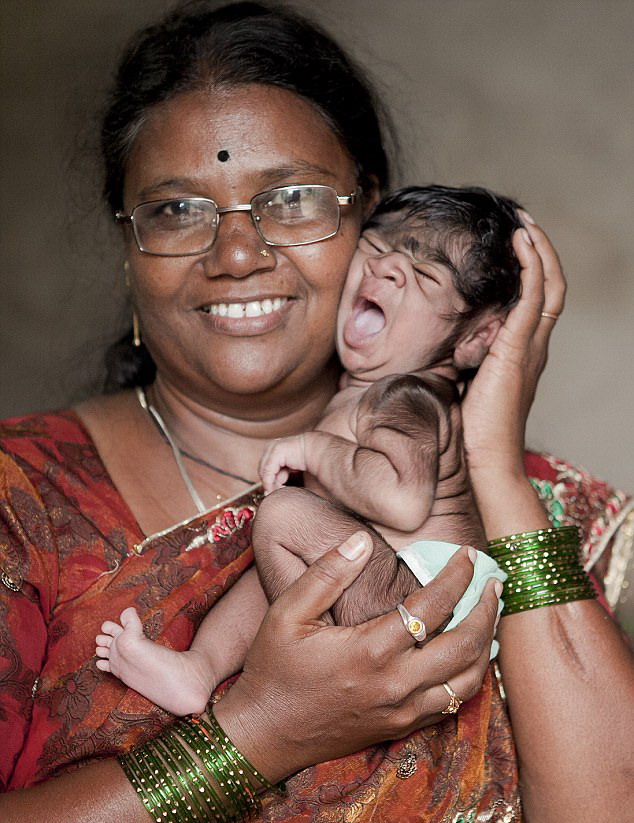 印度女婴患罕见狼人综合症 全身被黑色毛发覆盖