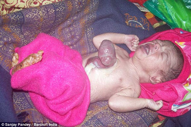 印度新生儿出生时心脏竟在体外 六天后仍活着属奇迹