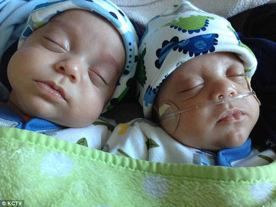美双胞胎兄弟先后相隔40天出生
