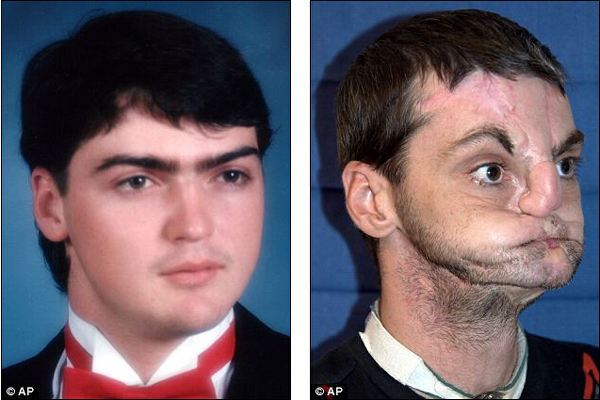美国毁容男经历36小时移植手术变身封面模特