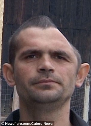 罗马尼亚男子意外失去半边头盖骨 术后复原如初