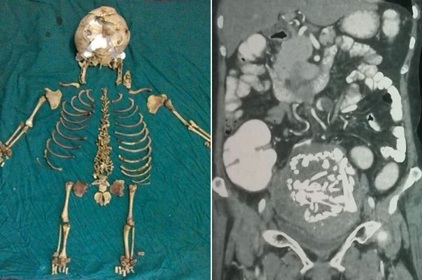 宫外孕胎死腹中 印妇女体内取出36年前死婴遗骨