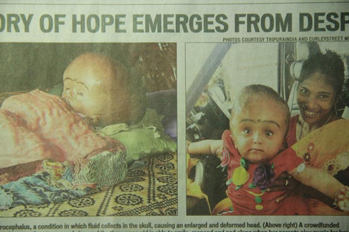 印度巨脑女童被村民当“异形” 手术后正常生活