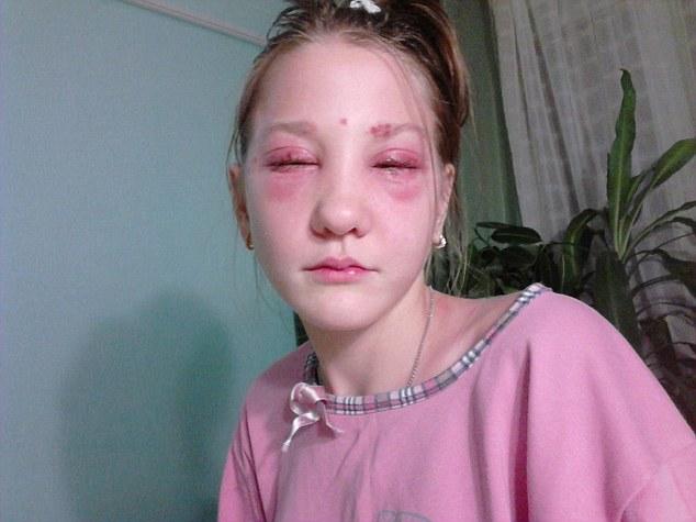 俄国女孩在美容院染睫毛 眼部灼伤毁容失明