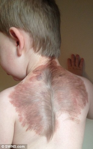 罕见皮肤病带来的两岁“天使”