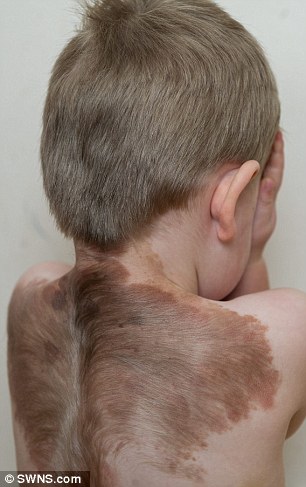 罕见皮肤病带来的两岁“天使”