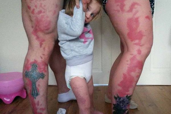 英国父母为有胎记女儿纹同款纹身 免其孤单难堪