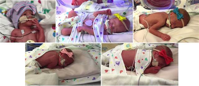 美女子产五胞胎女婴 46年来世界首例