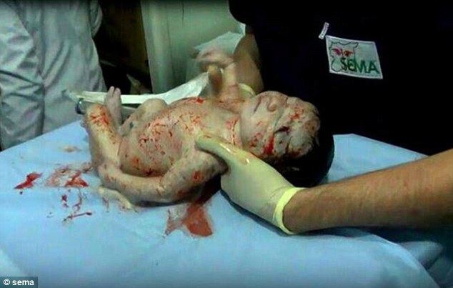 孕妇被炮火击中 叙利亚医生剖腹产救活“弹片婴儿”