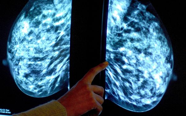 乳腺癌研究进展：相比杀死癌细胞 控制病情治疗效果更好