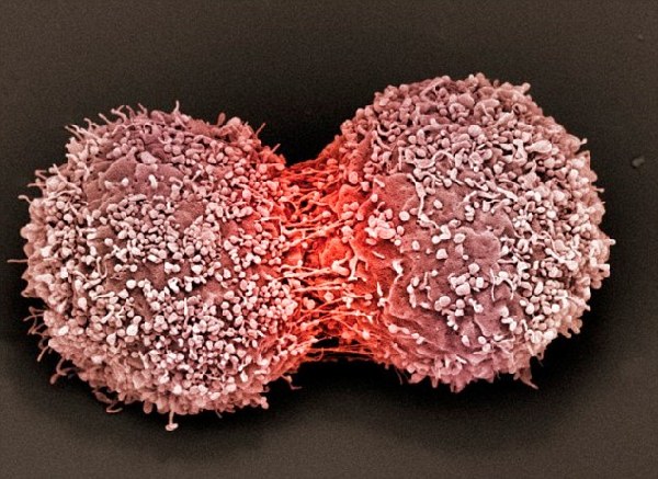 科学家：利用患者白细胞抗癌或掀治疗革命
