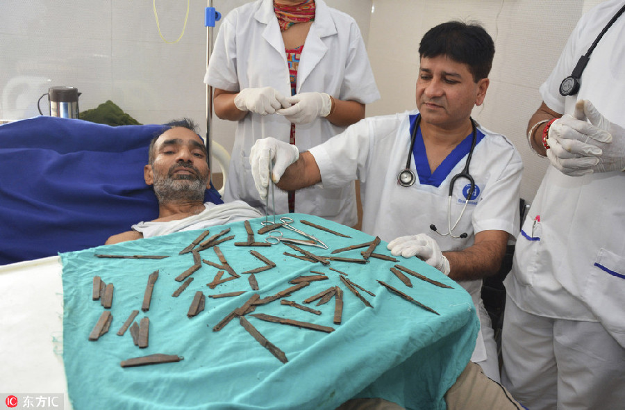 印度男子染上“吞刀”怪癖 胃里取出40把刀