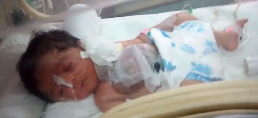巴基斯坦新生儿心脏裸露体外 身体机能正常(图)