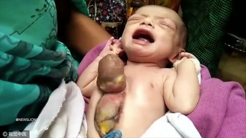 印度新生女婴心脏长在胸外 仅50%存活几率