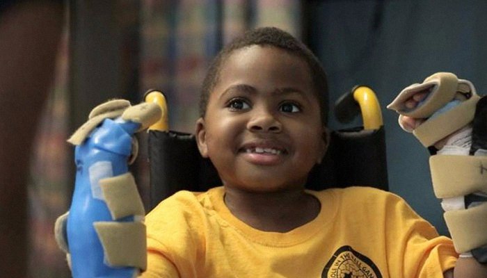 世界首例儿童异体双手移植手术宣布成功