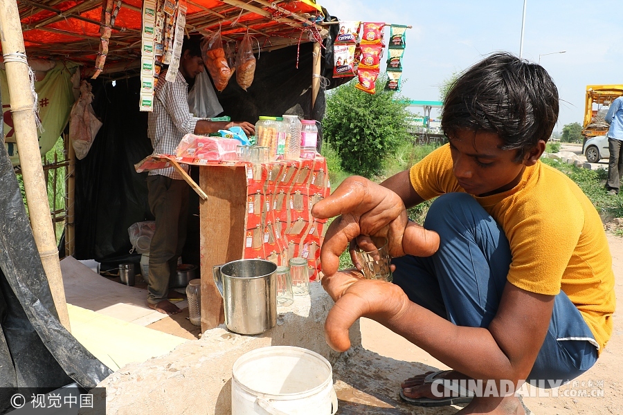 印度12岁男孩患罕见怪病 手掌长30厘米似芭蕉叶