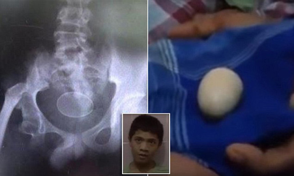 印尼惊现“下蛋男孩” 两年产20颗鸡蛋