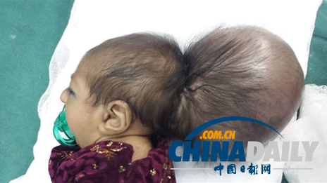 阿富汗双头女婴借助手术成功摘掉多余头颅