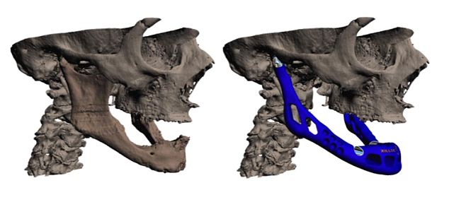 骨科治疗新突破：世界首例3D打印下颌移植手术细节公布