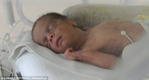 波兰三胞胎妈妈早产痛失一子 为保两胎半倒立75天