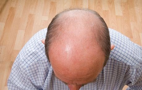 美科学家发现导致脱发蛋白质 生发药物或5年内面世