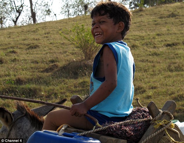 6岁男童患罕见疾病身背“龟壳” 英医生伸援手免费救治