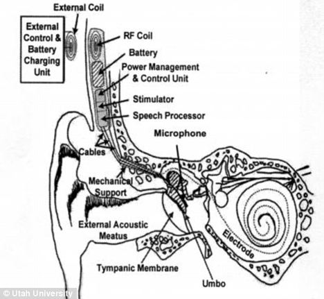 美科学家研发新型助听器 完全植入中耳避免部件暴露尴尬