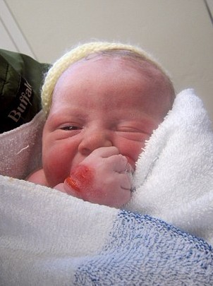 英国新生儿患罕见怪病 一碰皮肤就长水疱无法被拥抱
