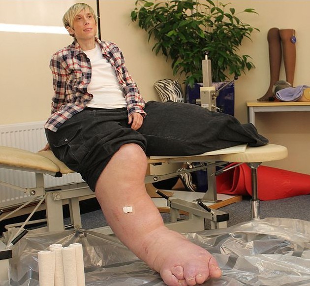 英女子患罕见疾病双腿重200斤 基因疗法有望助其再次走路