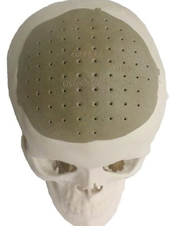 美国公司用3D打印技术为病人移植头骨