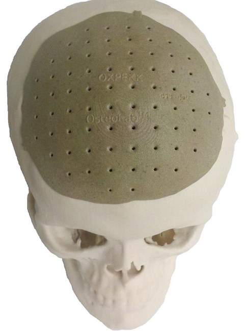 头骨也能打印！美国3D打印技术造福移植患者