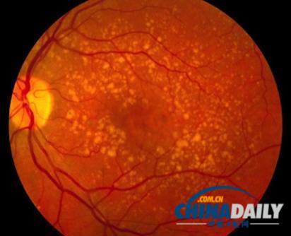 美国公司干细胞疗法见成效 一名盲人受试者看到光明