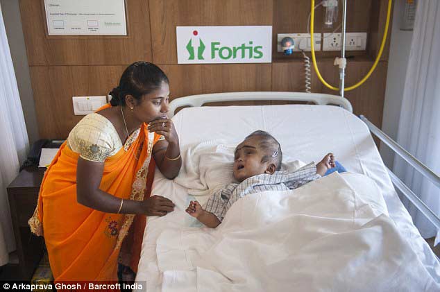 印度大头娃娃再接受手术 医院中度过圣诞节