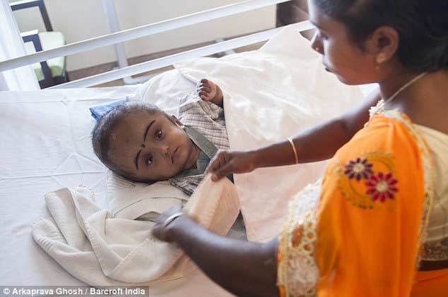 印度大头女婴接受头骨矫正术 头围缩小到正常范围