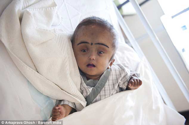 印度大头女婴接受头骨矫正术 头围缩小到正常范围