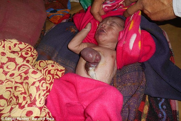 印度新生儿出生时心脏竟在体外 六天后仍活着属奇迹